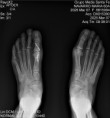 /album/hallux-valgus/rxxx-jpg/