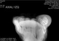 /album/hallux-valgus/rx-jpg/